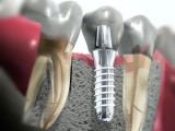 Зубные импланты - инновационная стоматологическая технология
