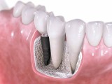 Зубные импланты - инновационная стоматологическая технология